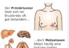 Beim Brustkrebs Tochtergeschwüre verhindern